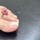 동탄내성발톱 이엠365의원 손발톱 클리닉 :: 엄지 내성발톱 교정 후기