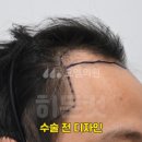 중앙헤어라인 이미지