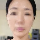 로이스의원 | 청담 티타늄리프팅 시술 일주일 후기 / 청담리투의원