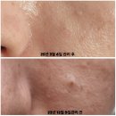 문제성남성 피부 연령대별 플라즈마 피부관리실제 사례 관리 후기