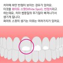 치아에 하얀반점 있는 바오들 있음? 이미지