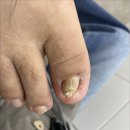 발라발라네일 - 창원시 의창구 용잠로 6 | 봉담발톱무좀 무좀 생긴 발톱 관리 3주 변화 후기 발라발라네일 봉담점
