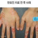 손가락 손바닥 발바닥 한포진 원인 및 증상, 피부 수포 물집 치료 이미지