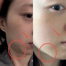 적금 | 부산 세르프 통증 없는 써마지 피부적금시술 솔직후기