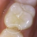 송주현 | 미백 치약을 쓰던 환자, 거여동 치과 에 오신 이유는?