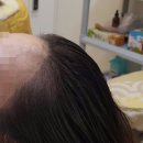 정 헤어라인 이미지