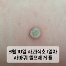 중앙2배수장 | 사마귀제거 사과식초 자연치유 민간요법 사마귀 셀프제거