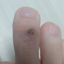 사마귀 자가치료~! 베이킹 소다 + 캐스터 오일 -1부-