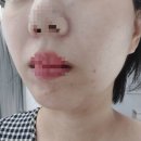 청담동피부과 스컬트라 풀페이스 엠레드클리닉 내돈내산 찐후기/얼굴필러 맛집