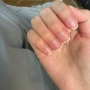 피플PC방 | 자가면역질환? 두드러기? 햇빛 알레르기 증상 기록