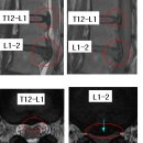 파리 님의 요추디스트 L1-2 , T12-L1의 MRI 판독입니다. 이미지