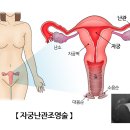 유한마취통증의학과의원 | [임신준비]나팔관조영술 생생후기