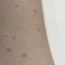 장미색 비강진 원인 ? 홈케어 관리로 효과본 후기