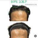 남포동두피문신잘하는곳 돕스칼프 헤어라인흉터커버교정 후기
