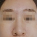 피코메드 | 40대 후반 모공관리(포텐자 시술 후기)