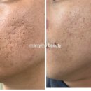 메리미에스테틱 | [안산모공축소,모공관리]여드름흉터 패인흉터전문점 플라즈마블라스트-메리미뷰티