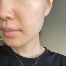 라인메디컬 | [부산] 센텀 한의원 피부과 “메디컬블룸” 트러블기미 컨택터 후기