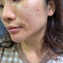 서울대입구백세한의원 | 서울대입구피부과 여드름 없애가는 4차까지 치료 후기 씀