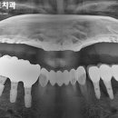 란치과기공소 | 비하동 치과 앞니 벌어짐(정중 이개, Diastema) 브릿지 보철치료 후기