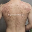거두리한의원 | 춘천 등 여드름 ㅣ 등에 나는 여드름, 등드름,몸드름