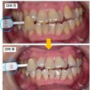 1442 | 60대 치아미백 받아도 될까요? 누런 치아 후기