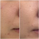 미담케어 | 창원 피부관리 상남동 에스테틱 미담뷰티 모공 재생관리 천방케어 300샷 후기