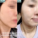 명동프라자 | 시청역 명동피부과 리쥬란힐러 2cc 금손 원장님 엠보 후기