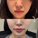 타이트짐 | 부산 올타이트리프팅 400샷 한 달 차 솔직 후기 + 효과, 부작용