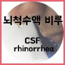 비루[rhinorrhea] 이미지