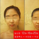 [일산](얼굴작아지는법+얼굴비대칭+머리작아지는법)고민하다 3set...결과는?? 이미지