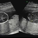 결실 | 압구정함춘 양수검사+미세결실 검사 후기