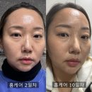 뿌리는 보톡스? 셀비아 줄기세포 홈케어 20일 리얼 후기!