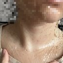 나음피부과의원 | 편평사마귀 어븀야그 레이저 제거 후기(시술 당일~7일차)