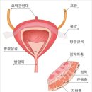 방광암, 전립선 약 이미지