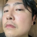 얼굴 좁쌀여드름 원인 없애기 라벨영 호랑이비누 후기