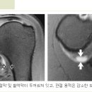 유착성 피막염(Adhesive Capsulitis); 오십견(Frozen Shoulder) 이미지