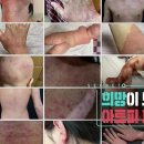 [872회] 생로병사의 비밀/아토피 피부염 희망이 보인다 이미지