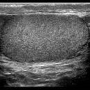 고환 초음파 검사[scrotal ultrasonography] 질환이란? 이미지