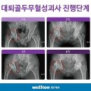 엉덩이 통증/ 대퇴골두 무혈성괴사/ 어느 병원에 가서 수술하나? 이미지