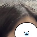 수헤어라인 - 군산시 | 헤어라인 모발이식 6개월 후기, 암흑기 없이 자연스러웠던 변화