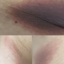 한림피부과의원 | 특정 약에 의한 피부발진, 고정약물발진으로 고생한 후기😭