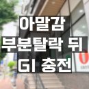 어금니 아말감 부분 탈락 : GI를 갈까? 레진을 할까 고민되면 컴온