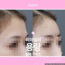 신사쑥사우나 | 이마필러 몇 cc 필요할까? 부위별 용량 완벽 가이드 (연예인 이마필러 잘하는 곳 성형외과 전문의)