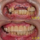 보일치과의원 | 연천치과 임플란트 실패원인 및 임플란트 재수술 실제후기