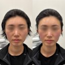 양주피부과 추천 중안부 리프팅 가능한 네오페이스+올리지오X 리얼 후기