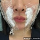 본시바 | 강남역피부과에서 푹 꺼진 팔자주름 리쥬엘 콜라겐주사 맞고왔어요! (10일간의 후기)