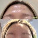 바른몸펴기(주간) | 이마 필러 1년 경과 후기 가격, 붓기, 아픔, 용량, 주름필러 효과 (1cc는 놉..)
