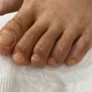 레푸스인하대역점 내성발톱 무좀발톱 발각질 문제성발 이미지