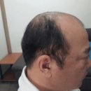 미니인생극장 마이웨이 자신감을 되찾아 주는 가발 제작 전문가 부산 곽민재 맞춤가발제작 연락처 위치