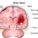 뇌출혈 초기 증상 구토 코피 포함 및 뇌출혈 골든타임 이미지